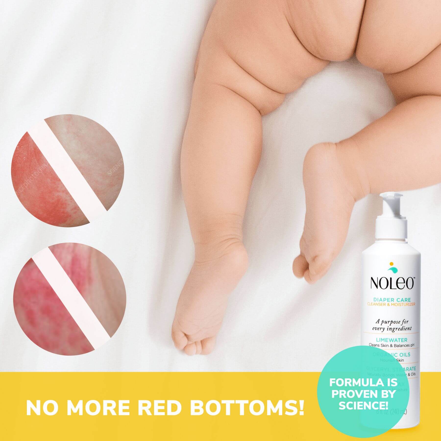 Baby's leg with diaper rash and a bottle of NOLEO diaper care product on a white background.
